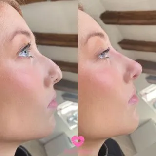 3 reasons you should get a Non-Surgical Nose Correction over a Surgical Rhinoplasty ⬇️

1. No surgery! Our Non-Surgical Nose Corrections are minimally invasive, no need to go under the knife for your dream nose! 
2. Instant results! Love your nose from the moment you leave our clinic! 
3. Affordable! Can you believe you can achieve your dream nose for just £250? Believe it! 

📍Locations:
💞Marylebone, London
💞Stevenage, Hertfordshire
💞Bury St Edmunds, Suffolk
💞Benfleet, Essex
💞Westcliff-on-Sea, Essex
💞Cambridge, Cambridgeshire 
💞Bristol 

🦋𝒮𝓅𝑒𝒸𝒾𝒶𝓁𝒾𝓈𝓉𝓈 𝒾𝓃 𝓃𝒶𝓉𝓊𝓇𝒶𝓁 𝓁𝑜𝑜𝓀𝒾𝓃𝑔 𝓇𝑒𝓈𝓊𝓁𝓉𝓈

#nosefiller #filler #aesthetics  #dermalfillers #nosejob #nonsurgicalnosejob #nonsurgicalrhinoplasty #lipfillers #aesthetic #lipinjections #russianlips #juvederm #beauty #rhinoplasty #skinbooster #cheekfillers #liquidrhinoplasty  #fillerinjections #hyaluronicacidfillers #fillerpic #fillertreatment #naturalfiller #dermalfillers #injectables #london #burystedmunds #stevenage #essex #cambridge #bristol