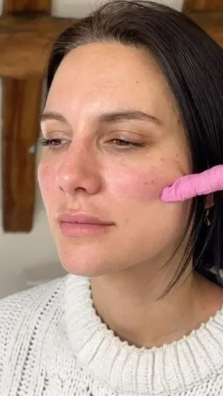 Did someone say volume?💖

Our Midface Rejuvenation Package is the perfect way to restore lost volume and turn back the clock on aging! 😍

This package consists of Tear Trough Correction to brighten the underyes and Midface Enhancement to support and restore volume! 

Book online now for £499

📍Locations:
💞Marylebone, London
💞Stevenage, Hertfordshire
💞Bury St Edmunds, Suffolk
💞Benfleet, Essex
💞Westcliff-on-Sea, Essex
💞Cambridge, Cambridgeshire 
💞Bristol 

🦋𝒮𝓅𝑒𝒸𝒾𝒶𝓁𝒾𝓈𝓉𝓈 𝒾𝓃 𝓃𝒶𝓉𝓊𝓇𝒶𝓁 𝓁𝑜𝑜𝓀𝒾𝓃𝑔 𝓇𝑒𝓈𝓊𝓁𝓉𝓈

#cheekfiller #cheekfillers #fillersinjection #undereyefiller #midfacefiller #midface #fillertreatment #nasolabialfolds #nasolabials #nasolabialfiller #nasolabialfoldfiller #nasolabialfillers #nasolabialfoldsfiller #nasolabialfoldfillers  #london #burystedmunds #stevenage #essex #cambridge #bristol