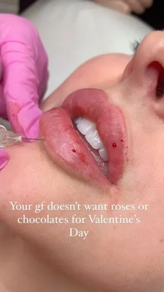 Tag your boyfriends ⬇️💖

📍Locations:
💞Marylebone, London
💞Stevenage, Hertfordshire
💞Bury St Edmunds, Suffolk
💞Benfleet, Essex
💞Westcliff-on-Sea, Essex
💞Cambridge, Cambridgeshire 
💞Bristol 

🦋𝒮𝓅𝑒𝒸𝒾𝒶𝓁𝒾𝓈𝓉𝓈 𝒾𝓃 𝓃𝒶𝓉𝓊𝓇𝒶𝓁 𝓁𝑜𝑜𝓀𝒾𝓃𝑔 𝓇𝑒𝓈𝓊𝓁𝓉𝓈 

#dermalfillers #lipfiller #fillers #injectables #cheekfillers #lipaugmentation #lipinjections #lipenhancement #juvederm #filler #cheekfiller #dermalfiller #restylane #jawlinefiller #chinfiller #lipgoals #russianlips #cosmeticinjectables #lips #aesthetics #jawfiller #nonsurgical #injections #london #burystedmunds #stevenage #essex #cambridge #bristol