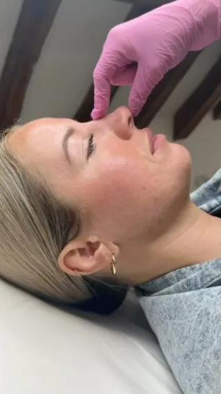 New nose, new confidence 💞

Can you believe you can achieve the nose of your dreams for just £250?! 💖

📍Locations:
💞Marylebone, London
💞Stevenage, Hertfordshire
💞Bury St Edmunds, Suffolk
💞Benfleet, Essex
💞Cambridge, Cambridgeshire 
💞Bristol 

🦋𝒮𝓅𝑒𝒸𝒾𝒶𝓁𝒾𝓈𝓉𝓈 𝒾𝓃 𝓃𝒶𝓉𝓊𝓇𝒶𝓁 𝓁𝑜𝑜𝓀𝒾𝓃𝑔 𝓇𝑒𝓈𝓊𝓁𝓉𝓈

#nosefiller #filler #aesthetics  #dermalfillers #nosejob #nonsurgicalnosejob #nonsurgicalrhinoplasty #lipfillers #aesthetic #lipinjections #russianlips #juvederm #beauty #rhinoplasty #skinbooster #cheekfillers #liquidrhinoplasty #london #burystedmunds #stevenage #essex #cambridge #bristol