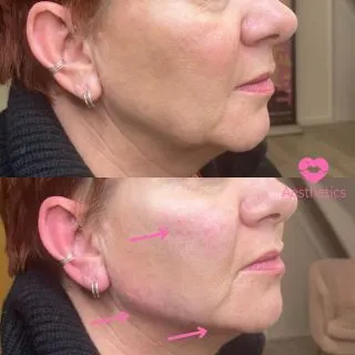 Support, lift and tighten 🌸

Gravity can be against us as we age! Here we have used dermal filler to replace the volume in the cheeks to create some support for the lower face, we also added to the jawline and prejowl area in order to smooth and redefine 💞

Young at Heart Package - 5ml completely bespoke to you and your needs ✨

Just £675 💖

📍Locations:
💞Marylebone, London
💞Stevenage, Hertfordshire
💞Bury St Edmunds, Suffolk
💞Benfleet, Essex
💞Cambridge, Cambridgeshire 
💞Bristol 

🦋𝒮𝓅𝑒𝒸𝒾𝒶𝓁𝒾𝓈𝓉𝓈 𝒾𝓃 𝓃𝒶𝓉𝓊𝓇𝒶𝓁 𝓁𝑜𝑜𝓀𝒾𝓃𝑔 𝓇𝑒𝓈𝓊𝓁𝓉𝓈

#cheekfiller #cheekfillers #fillersinjection #undereyefiller #midfacefiller #midface #fillertreatment #nasolabialfolds #nasolabials #nasolabialfiller #nasolabialfoldfiller #nasolabialfillers #nasolabialfoldsfiller #nasolabialfoldfillers  #london #burystedmunds #stevenage #essex #cambridge #bristol