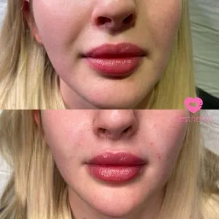 Say no to Nose to Mouth Lines 🙅‍♀️💖

As we age, our mid-face section where our largest ‘fat pads’ are situated drop, which pulls the skin down. This causes the skin in our lower section to develop deep and noticeable lines such as the nasolabial folds, marionettes, perioral lines and jowls. Dermal fillers smooth these areas, softening the lines and replacing the loss of volume. Leaving you looking 10 years younger and your skin rejuvenated and refreshed 💞

📍Locations:
💞Marylebone, London
💞Stevenage, Hertfordshire
💞Bury St Edmunds, Suffolk
💞Benfleet, Essex
💞Westcliff-on-Sea, Essex
💞Cambridge, Cambridgeshire 
💞Bristol 

🦋𝒮𝓅𝑒𝒸𝒾𝒶𝓁𝒾𝓈𝓉𝓈 𝒾𝓃 𝓃𝒶𝓉𝓊𝓇𝒶𝓁 𝓁𝑜𝑜𝓀𝒾𝓃𝑔 𝓇𝑒𝓈𝓊𝓁𝓉𝓈 

#dermalfillers #lipfiller #fillers #injectables #cheekfillers #lipaugmentation #lipinjections #lipenhancement #juvederm #filler #cheekfiller #dermalfiller #restylane #jawlinefiller #chinfiller #lipgoals #russianlips #cosmeticinjectables #lips #aesthetics #jawfiller #nonsurgical #injections #london #burystedmunds #stevenage #essex #cambridge #bristol