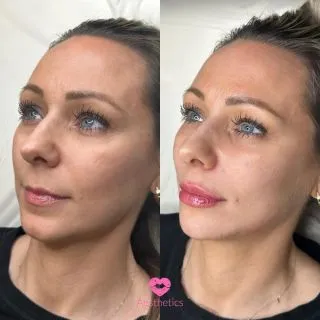 The most beautiful thing you can wear is confidence ✨

This client oozed confidence after her Young at Heart Treatment 🥰 we placed dermal filler within the Jawline, Chin, Prejowl, Midface and Lips to restore volume and definition leaving her feeling as good as she looks ☺️

Young at Heart Package - £675

📍Locations:
💞Marylebone, London
💞Stevenage, Hertfordshire
💞Bury St Edmunds, Suffolk
💞Benfleet, Essex
💞Cambridge, Cambridgeshire 
💞Bristol 

🦋𝒮𝓅𝑒𝒸𝒾𝒶𝓁𝒾𝓈𝓉𝓈 𝒾𝓃 𝓃𝒶𝓉𝓊𝓇𝒶𝓁 𝓁𝑜𝑜𝓀𝒾𝓃𝑔 𝓇𝑒𝓈𝓊𝓁𝓉𝓈

#cheekfiller #cheekfillers #fillersinjection #undereyefiller #midfacefiller #midface #fillertreatment #nasolabialfolds #nasolabials #nasolabialfiller #nasolabialfoldfiller #nasolabialfillers #nasolabialfoldsfiller #nasolabialfoldfillers  #london #burystedmunds #stevenage #essex #cambridge #bristol