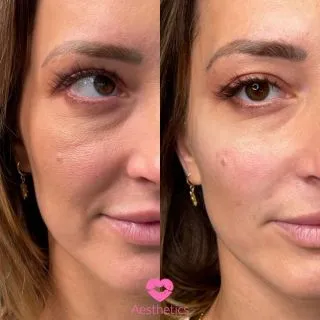 Turn the clock back in time 🕥

As we age our fat pads slip causing loss of volume in the cheeks, and heaviness around the mouth! Here we have turned back time, using dermal filler to replace the volume in the cheeks, and smooth the nasolabial folds 💞

3ml Personalised Filler Package - £495 

📍Locations:
💞Marylebone, London
💞Stevenage, Hertfordshire
💞Bury St Edmunds, Suffolk
💞Benfleet, Essex
💞Westcliff-on-Sea, Essex
💞Cambridge, Cambridgeshire 
💞Bristol 

🦋𝒮𝓅𝑒𝒸𝒾𝒶𝓁𝒾𝓈𝓉𝓈 𝒾𝓃 𝓃𝒶𝓉𝓊𝓇𝒶𝓁 𝓁𝑜𝑜𝓀𝒾𝓃𝑔 𝓇𝑒𝓈𝓊𝓁𝓉𝓈

#cheekfiller #cheekfillers #fillersinjection #undereyefiller #midfacefiller #midface #fillertreatment #nasolabialfolds #nasolabials #nasolabialfiller #nasolabialfoldfiller #nasolabialfillers #nasolabialfoldsfiller #nasolabialfoldfillers #fillerinjections #hyaluronicacidfillers #fillerpic #fillertreatment #naturalfiller #dermalfillers #injectables #london #burystedmunds #stevenage #essex #cambridge #bristol