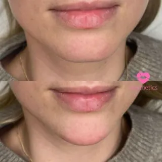 It’s more than just Chin Enhancement…it’s:

💞A confidence boost
💞A balancing of profile 
💞A face slimming technique

2ml Chin Enhancement - £350 

📍Locations:
💞Marylebone, London
💞Stevenage, Hertfordshire
💞Bury St Edmunds, Suffolk
💞Benfleet, Essex
💞Westcliff-on-Sea, Essex
💞Cambridge, Cambridgeshire 
💞Bristol 

🦋𝒮𝓅𝑒𝒸𝒾𝒶𝓁𝒾𝓈𝓉𝓈 𝒾𝓃 𝓃𝒶𝓉𝓊𝓇𝒶𝓁 𝓁𝑜𝑜𝓀𝒾𝓃𝑔 𝓇𝑒𝓈𝓊𝓁𝓉𝓈

#chin #chinfiller #fillersinjection #fillerinjection #chinfillers #dermafiller #lipfillerlondon #fillerinjections #hyaluronicacidfillers #fillerpic #fillertreatment #naturalfiller #facialfillers #lipfillersuk #russianlip #london #burystedmunds #stevenage #essex #cambridge #bristol