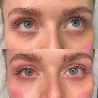 Eyes as bright as your engagement ring should be 💍

Correct hollowness causing shadowing with our Tear Trough Correction for just £275 💞

📍Locations:
💞Marylebone, London
💞Stevenage, Hertfordshire
💞Bury St Edmunds, Suffolk
💞Benfleet, Essex
💞Cambridge, Cambridgeshire 
💞Bristol 

🦋𝒮𝓅𝑒𝒸𝒾𝒶𝓁𝒾𝓈𝓉𝓈 𝒾𝓃 𝓃𝒶𝓉𝓊𝓇𝒶𝓁 𝓁𝑜𝑜𝓀𝒾𝓃𝑔 𝓇𝑒𝓈𝓊𝓁𝓉𝓈

#teartrough #teartroughfillers #teartroughfiller #fillersinjection #cheekfillers #teardrop #undereye #undereyefiller #undereyebags #undereyecircles #undereyetreatment #darkcirclesundereyes #undereyefillers #undereyerejuvenation  #london #burystedmunds #stevenage #essex #cambridge #bristol