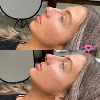 Personalised to you 🌷

Whether you are wanting an overall refresh or a couple of tweakments, our personalised packages are the perfect way to create the perfect treatment plan for you! 

Pssst…if you don’t know how many ml’s to book for, count the areas you’re considering and book in for that number of ml’s, we can always adjust on the day depending on your needs! 

This stunning client simply wanted to create the perfect profile, our Signature Heart Breaker Package was the perfect way to lift the cheeks, elongate the face and smooth the nose 💖

📍Locations:
💞Marylebone, London
💞Stevenage, Hertfordshire
💞Bury St Edmunds, Suffolk
💞Benfleet, Essex
💞Westcliff-on-Sea, Essex
💞Cambridge, Cambridgeshire 
💞Bristol 

🦋𝒮𝓅𝑒𝒸𝒾𝒶𝓁𝒾𝓈𝓉𝓈 𝒾𝓃 𝓃𝒶𝓉𝓊𝓇𝒶𝓁 𝓁𝑜𝑜𝓀𝒾𝓃𝑔 𝓇𝑒𝓈𝓊𝓁𝓉𝓈

#dermalfillers #lipfiller #fillers #injectables #cheekfillers #lipfillersessex #lipfillerlondon #lipfilleruk #lipglosslover #lipgoals #liptreatment #lipfillerbeforeandafter #lipsfiller #fillersinjection #fillerlips #lipfillerslondon #dermafillers #facialfillers #lipfillersuk #russianlip #london #burystedmunds #stevenage #essex #cambridge #bristol