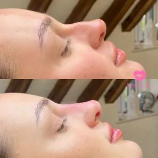 The girls don’t want chocolates for Valentine’s…they want a new nose! 🎀

Gift cards available to buy online…tag your bf’s 💞

Non-Surgical Nose Correction 
📍Locations:
💞Marylebone, London
💞Stevenage, Hertfordshire
💞Bury St Edmunds, Suffolk
💞Benfleet, Essex
💞Westcliff-on-Sea, Essex
💞Cambridge, Cambridgeshire 
💞Bristol 

🦋𝒮𝓅𝑒𝒸𝒾𝒶𝓁𝒾𝓈𝓉𝓈 𝒾𝓃 𝓃𝒶𝓉𝓊𝓇𝒶𝓁 𝓁𝑜𝑜𝓀𝒾𝓃𝑔 𝓇𝑒𝓈𝓊𝓁𝓉𝓈

#nosefiller #filler #aesthetics  #dermalfillers #nosejob #nonsurgicalnosejob #nonsurgicalrhinoplasty #lipfillers #aesthetic #lipinjections #russianlips #juvederm #beauty #rhinoplasty #skinbooster #cheekfillers #liquidrhinoplasty  #fillerinjections #hyaluronicacidfillers #fillerpic #fillertreatment #naturalfiller #dermalfillers #injectables #london #burystedmunds #stevenage #essex #cambridge #bristol