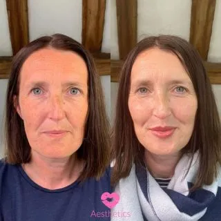 Come with us on a journey…💖

Our lovely and loyal client came to us a year ago looking for an overall rejuvenation and replacement of lost volume! 

Over a couple of sessions to build the filler we have restored the volume in her cheeks, rehydrated her lips and redefined her lower face! 💘

Filler can be a building process in order to achieve the results you want, join us on your journey today 💖

📍Locations:
💞Marylebone, London
💞Stevenage, Hertfordshire
💞Bury St Edmunds, Suffolk
💞Benfleet, Essex
💞Westcliff-on-Sea, Essex
💞Cambridge, Cambridgeshire 
💞Bristol 

🦋𝒮𝓅𝑒𝒸𝒾𝒶𝓁𝒾𝓈𝓉𝓈 𝒾𝓃 𝓃𝒶𝓉𝓊𝓇𝒶𝓁 𝓁𝑜𝑜𝓀𝒾𝓃𝑔 𝓇𝑒𝓈𝓊𝓁𝓉𝓈

#dermalfillers #lipfiller #fillers #injectables #cheekfillers #lipfillersessex #lipfillerlondon #lipfilleruk #lipglosslover #lipgoals #liptreatment #lipfillerbeforeandafter #lipsfiller #fillersinjection #fillerlips #lipfillerslondon #dermafillers #facialfillers #lipfillersuk #russianlip #london #burystedmunds #stevenage #essex #cambridge #bristol